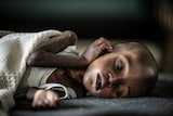 Two-year-old Salah is severely malnourished and suspected of having tuberculosis.